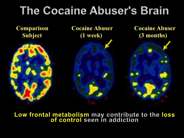 how cocaine affects the brain
